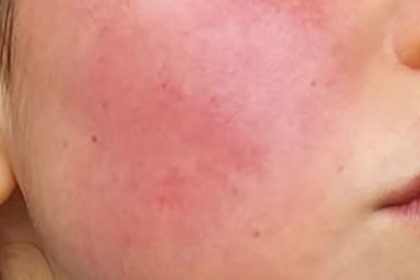 Redness