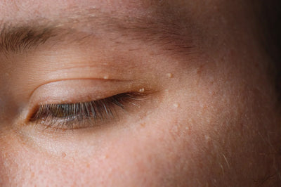 What causes milia and how do you get rid of them