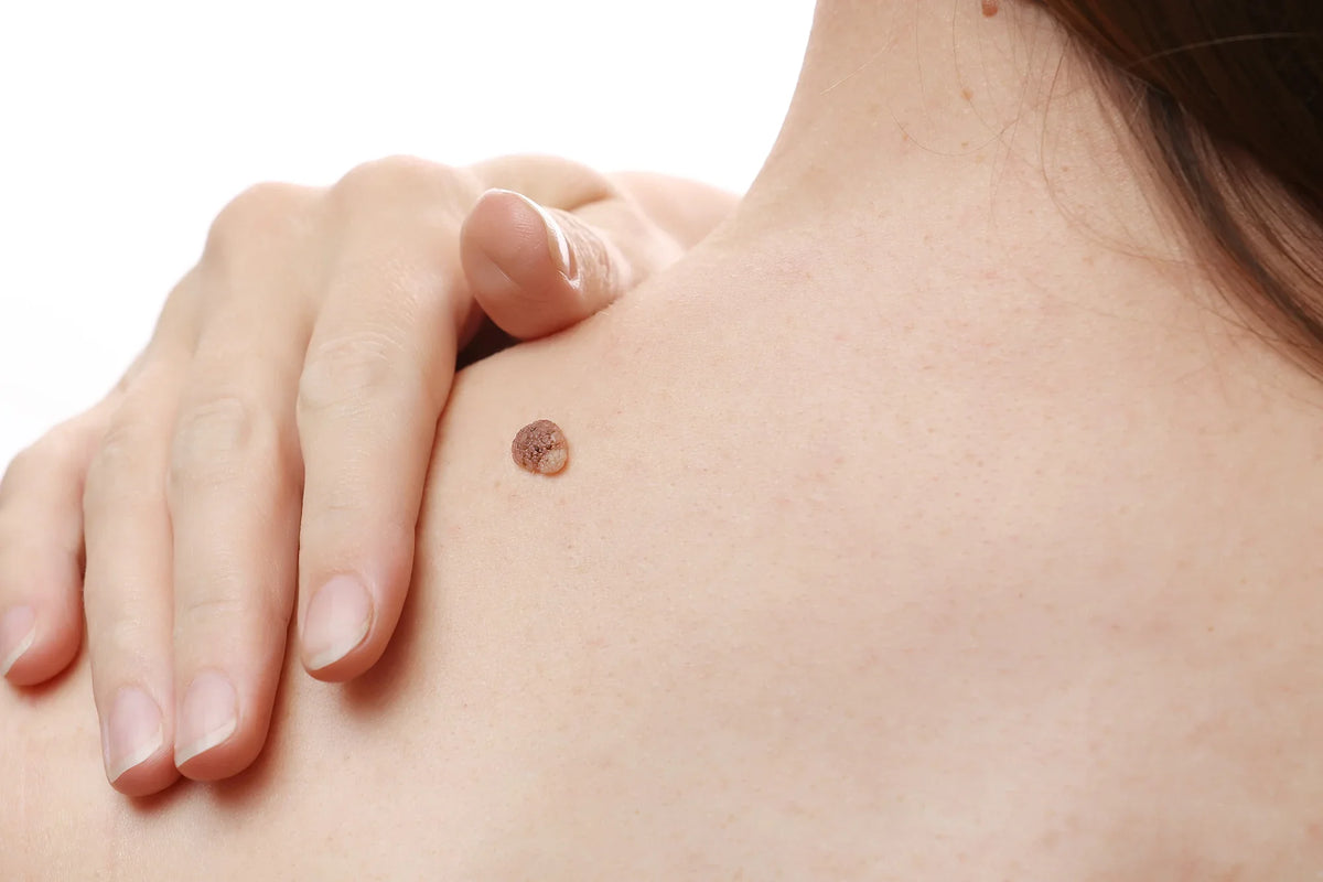 Warts: Causes, Types, and Treatments