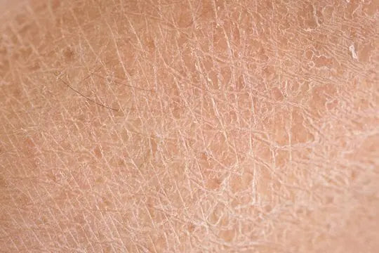 Dry skin