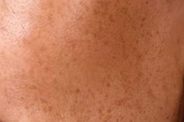 Uneven tone