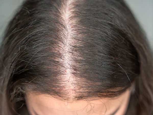 Thinning hair